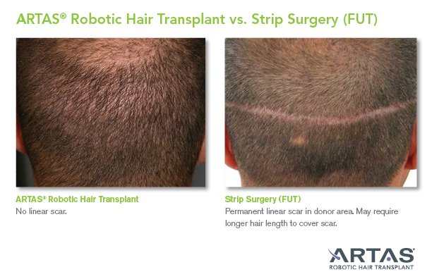 Robotic Hair Transplant | ARTAS | Dallas, TX